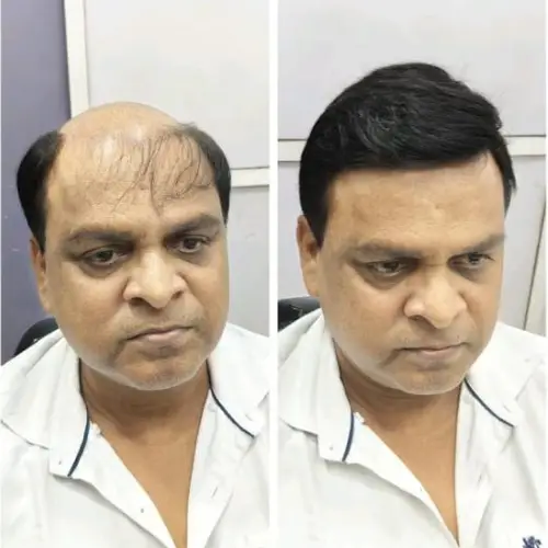Natural hair patch fitting at Hercovits Hair Studio Santacruz