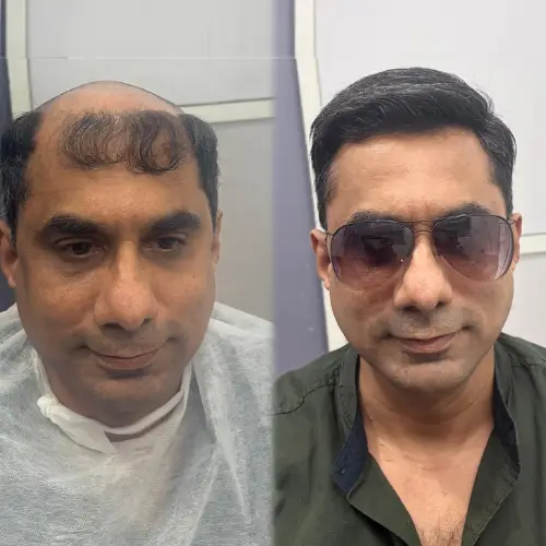 Hair wig for men at Hercovits Hair Studio Santacruz